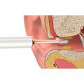 Bebird T15 Smart Visual Ear-Clean korvanpuhdistin kameralla - 85 minuuttia - Valkoinen